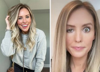 an-influencer-has-been-sharing-her-botched-botox-on-instagram-stories-and-followers-can't-…