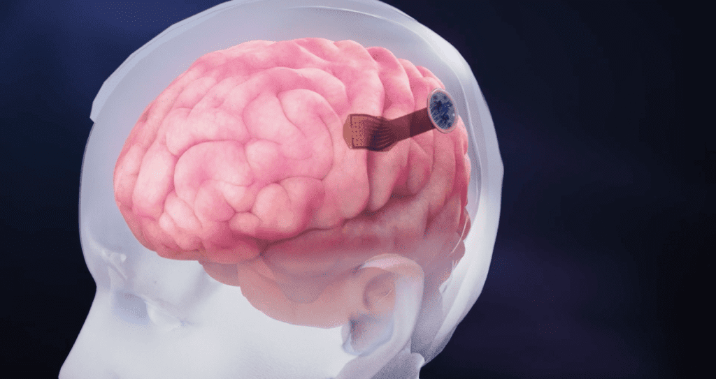 new-brain-implant-is-five-times-thinner-than-a-human-hair-–-breaking-latest-news