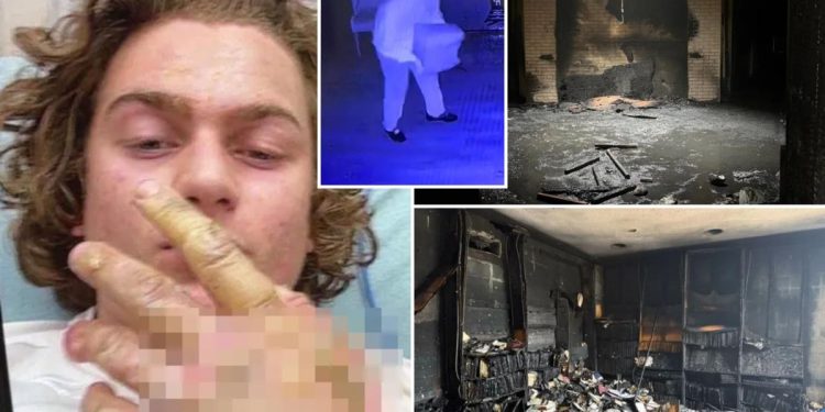 teen-accused-of-torching-mississippi-synagogue-posted-hospital-selfie-of-severe-burns-…